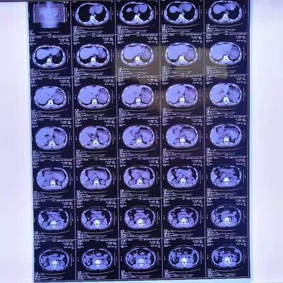 Reasonable Cost Medical X ray Films Featuring High Image Stability Providing Clear and Precise Medical Diagnostic Images