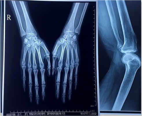 195 Micron PET Blue Laser X Ray Film A3 A4 Digital Printing Film