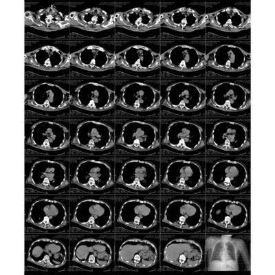 Advanced Blue Laser Printable Radiographic Laser Film With Thermal Print Process