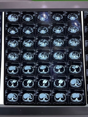Medical Equipment Blue Density Laser X Ray Thermal Print Film